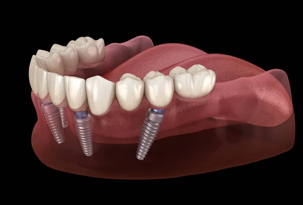 Мандибулярний Протез Системи Підтримується Імплантатами Медично Точна Ілюстрація Концепції Зубів — стокове фото