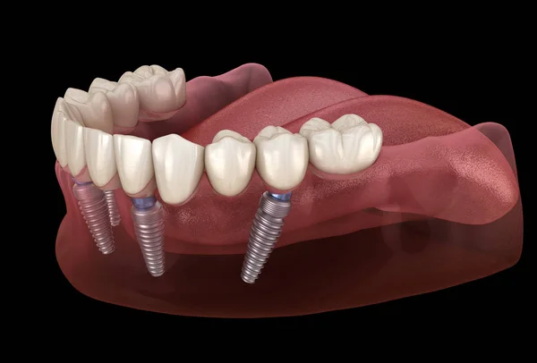 Prothèse Mandibulaire Tout Sur Système Soutenu Par Des Implants Illustration — Photo