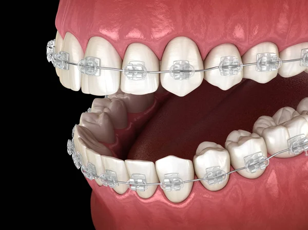 Denti Bretelle Chiare Nelle Gengive Illustrazione Dentale Clinicamente Accurata — Foto Stock