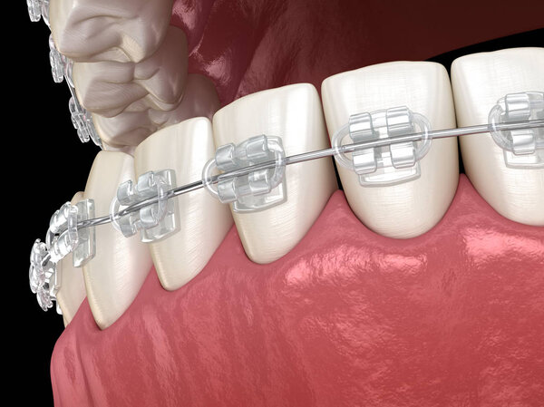 Teeth Clear braces in gums. Medically accurate dental 3D illustration