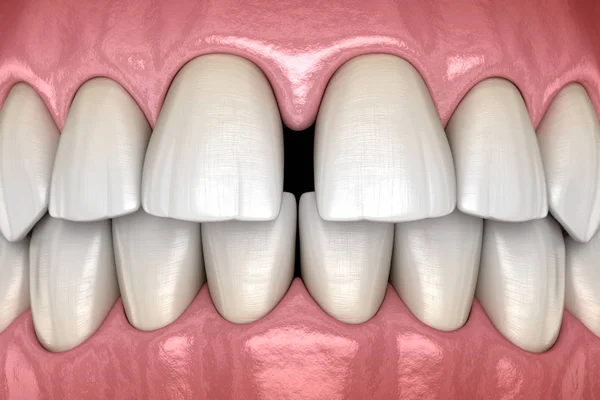 Diastema Dentes Incisivos Centrais Disfunção Dentária Ilustração Conceito — Fotografia de Stock