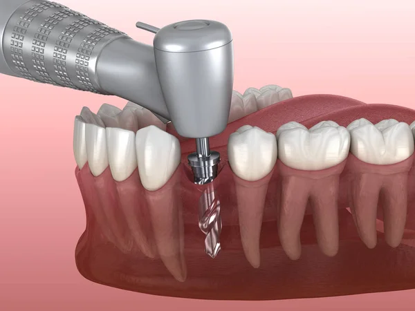 Borrning Ben Medan Tandimplantat Placeras Medicinskt Korrekt Illustration Mänskliga Tänder — Stockfoto