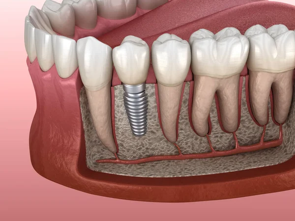 Prämolare Zahnsanierung Mit Implantat Medizinisch Genaue Abbildung Des Konzepts Menschlicher — Stockfoto