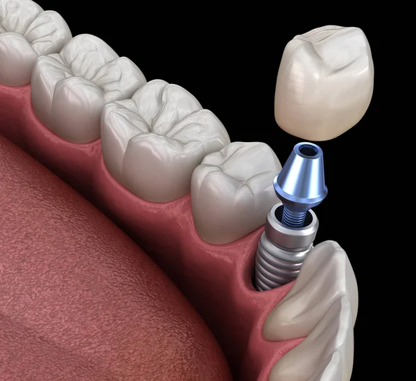 Premolární Zotavení Zubů Implantátem Lékařsky Přesná Ilustrace Konceptu Lidských Zubů — Stock fotografie