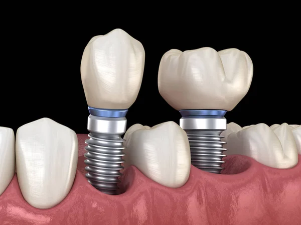 Premolar 和摩尔牙冠安装超过植入物 人类牙齿和假牙的3D插图 — 图库照片