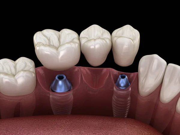 Puente Dental Soportado Por Implantes Ilustración Médicamente Precisa Del Concepto — Foto de Stock