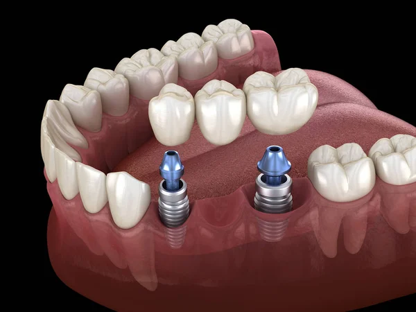 Most Stomatologiczny Wspomagany Implantami Medycznie Dokładna Ilustracja Koncepcji Ludzkich Zębów — Zdjęcie stockowe