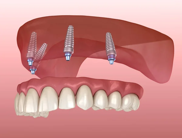 上颌骨假体 牙龈全长在4个系统上 植入物支持 医学上准确的人类牙齿和假牙3D图像 — 图库照片