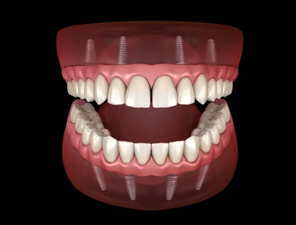 Çikletli Maxillary Mandibular Protez Hepsi Implantlarla Desteklenen Sistemde Nsan Dişlerinin — Stok fotoğraf