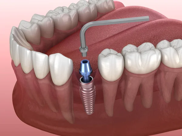 Procedura Mocowania Implantu Medycznie Dokładna Ilustracja Koncepcji Ludzkich Zębów Protez — Zdjęcie stockowe