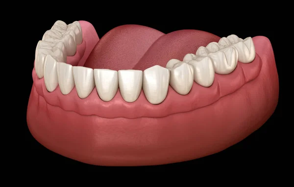 Prótese Mandibular Com Gengiva Tudo Sistema Suportado Por Implantes Ilustração — Fotografia de Stock