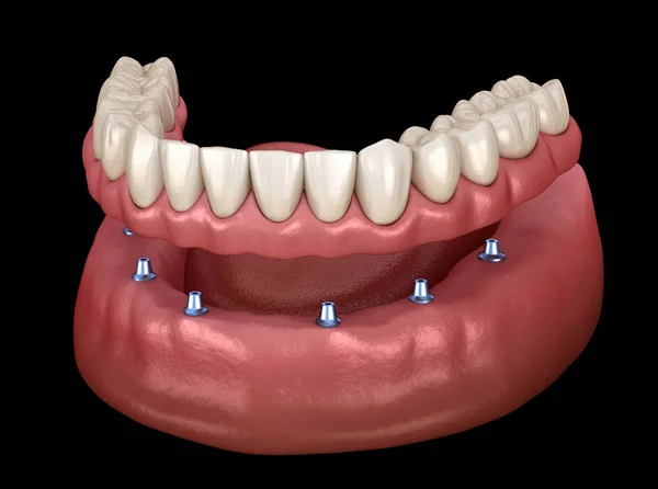 Çikletli Çene Protezi Hepsi Implantlarla Desteklenen Sistemde Nsan Dişleri Protez — Stok fotoğraf