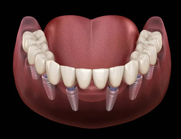 Állkapocs Protézis Mind Rendszer Által Támogatott Implantátumok Orvosilag Pontos Illusztráció — Stock Fotó