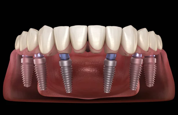 Állkapocs Protézis Mind Rendszer Által Támogatott Implantátumok Orvosilag Pontos Illusztráció — Stock Fotó