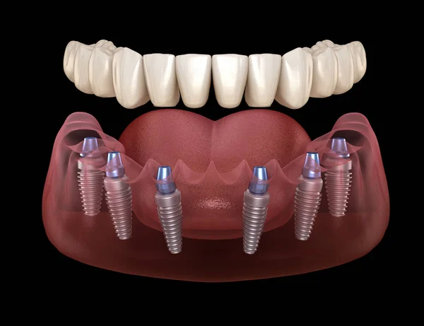 下颌骨假体全部安装在6个由植入物支撑的系统上 医学上准确的人类牙齿和假牙概念三维图像 — 图库照片