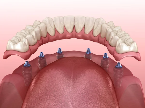 Mandibulární Protéza Gumou Vše Systému Podepřeno Implantáty Lékařsky Přesná Ilustrace — Stock fotografie