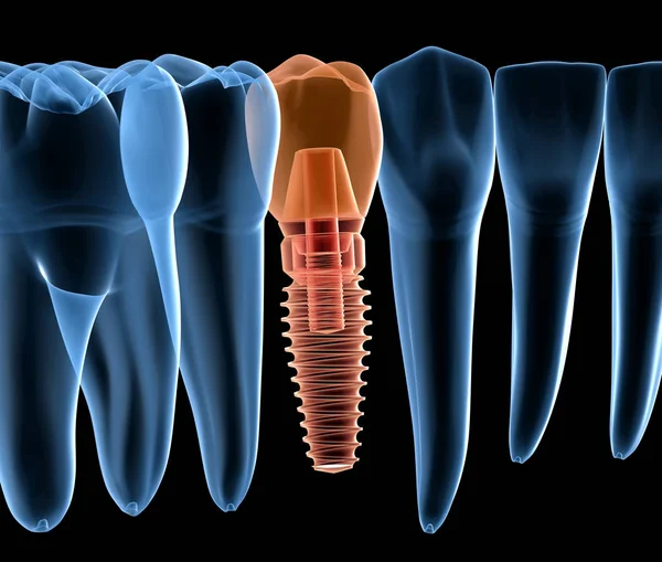 Recupero Premolare Dei Denti Con Impianto Vista Raggi Illustrazione Clinicamente — Foto Stock