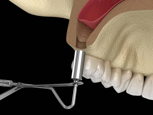 Sinus Lift Surgery Hinzufügen Neuer Knochen Illustration — Stockfoto