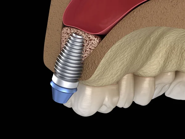 Sinus Lift Chirurgie Instalace Implantátu Ilustrace — Stock fotografie