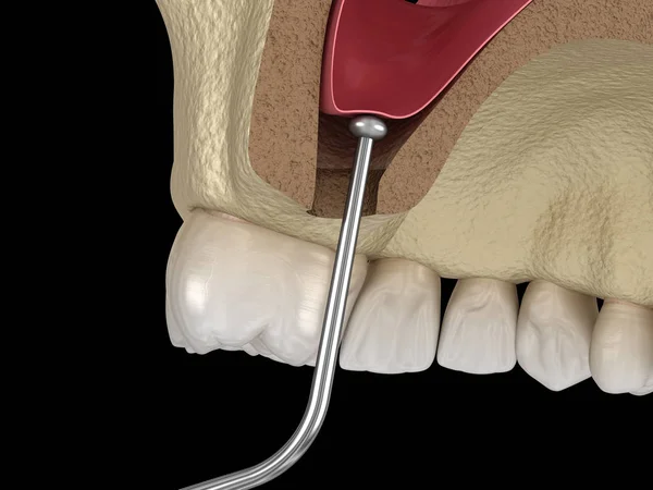 Chirurgie Sinusale Membrane Sinusale Mouvement Illustration — Photo