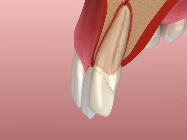Procedimento Instalação Folheado Sobre Incisivo Central Incisivo Lateral Vista Cortada — Fotografia de Stock