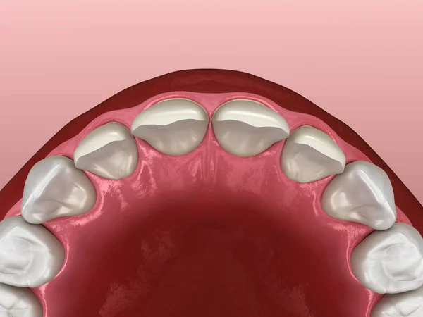 Teeth preparation for Veneer installation procedure over central incisor and lateral incisor. Medically accurate tooth 3D illustration