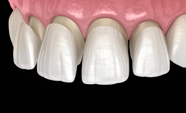 在中央门牙和侧牙上安装嵌板的程序 医学上准确的牙齿3D图像 — 图库照片