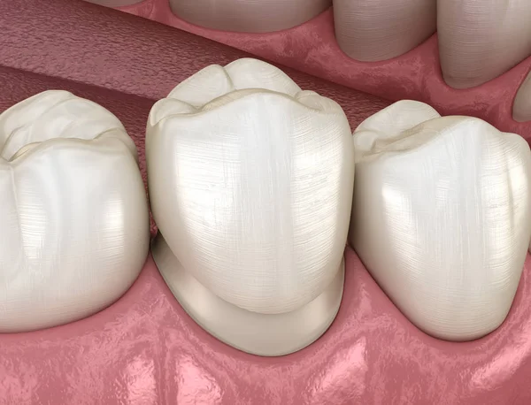 Persiapan Gigi Premolar Untuk Penempatan Mahkota Gigi Ilustrasi Akurat Secara — Stok Foto