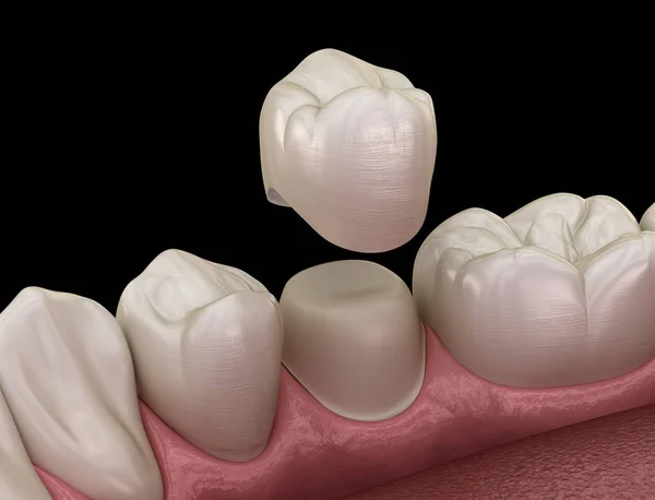 Dente Premolare Preparato Posizionamento Della Corona Dentale Illustrazione Clinicamente Accurata — Foto Stock