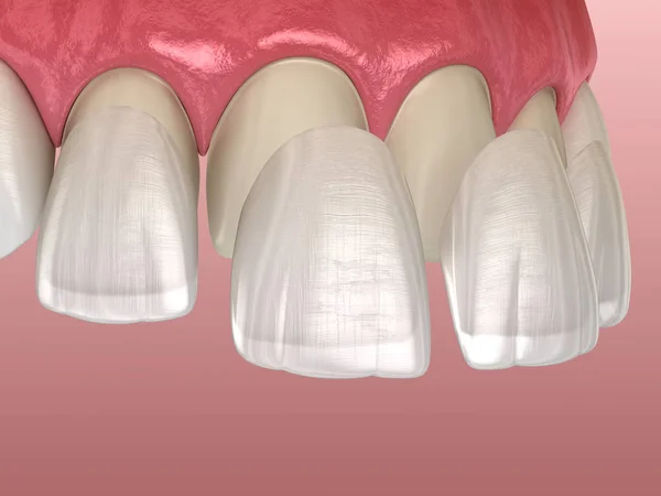 中央インジケータと横インジケータ上のベネー設置手順 医学的に正確な歯3Dイラスト — ストック写真