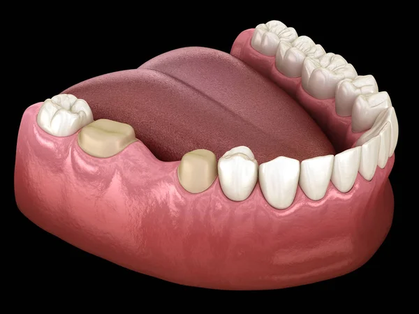 Dente Molare Premolare Preparato Posizionamento Ponti Dentali Illustrazione Clinicamente Accurata — Foto Stock