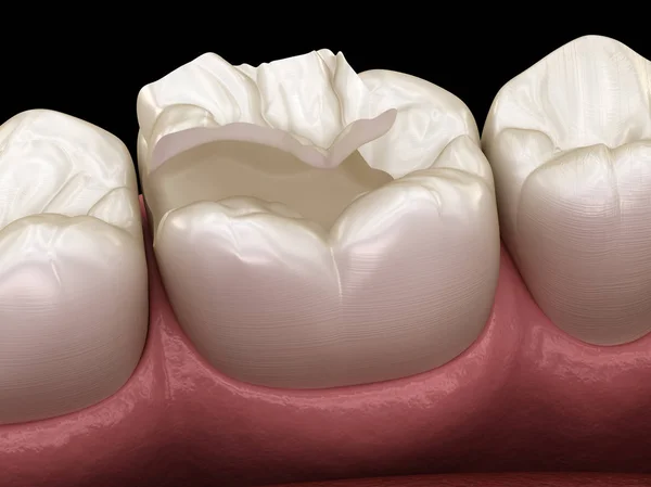 Вставьте Керамическую Корону Зуб Медицинская Точность Иллюстрации Лечения Человеческих Зубов — стоковое фото
