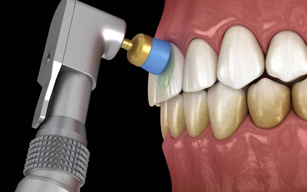 Zahnpolierverfahren Mit Professioneller Bürste Und Gel Medizinisch Korrekte Darstellung — Stockfoto