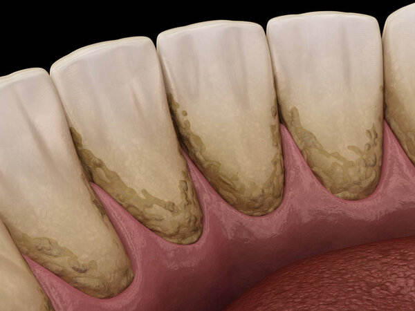 Tartar and bactrail tooth plaque, lower jaw. Medically accurate 3D illustration of human teeth treatment