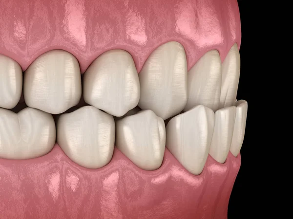 Unterbiss Zahnverschluss Malokklusion Der Zähne Medizinisch Korrekte Abbildung Der Zähne — Stockfoto