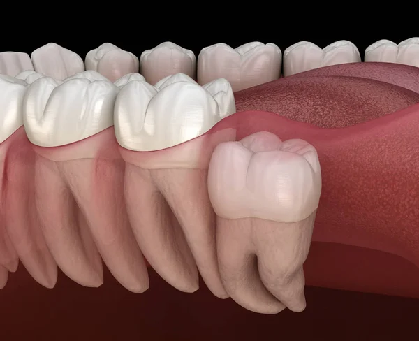 Zub Moudrosti Nečinností Molární Zub Medově Přesný Zubní Zub Ilustrace — Stock fotografie