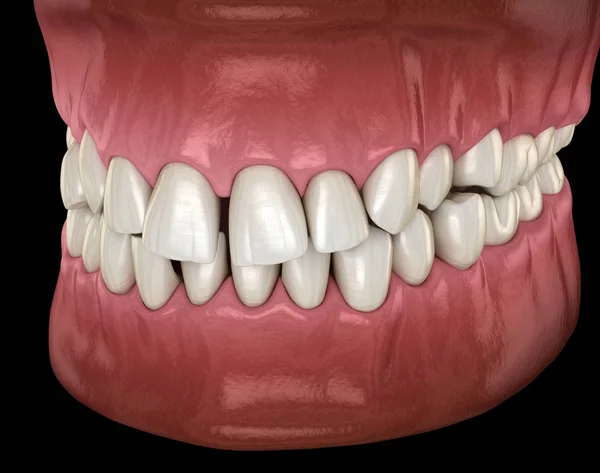 健康的人类牙齿与正常的遮挡 侧视图 医学上精确的牙齿 — 图库照片
