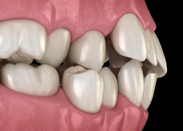 Ανώμαλη Θέση Δοντιών Ορθοδοντική Έννοια Ιατρικά Ακριβές Δόντι Εικονογράφηση — Φωτογραφία Αρχείου