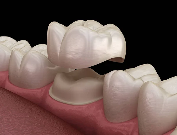 Förberedd Molar Tand För Tandkrona Placering Medicinskt Korrekt Illustration — Stockfoto