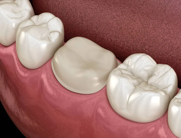 Dente Molar Preparado Para Colocação Coroa Dentária Ilustração Medicamente Precisa — Fotografia de Stock