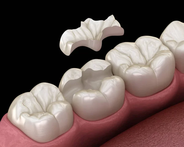 歯の上にセラミッククラウン固定を埋め込みます 人間の歯の治療の医学的に正確な3Dイラスト — ストック写真
