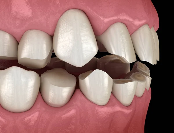牙齿磨损 布鲁克斯病 导致牙齿组织丧失 医学上准确的牙齿3D图像 — 图库照片