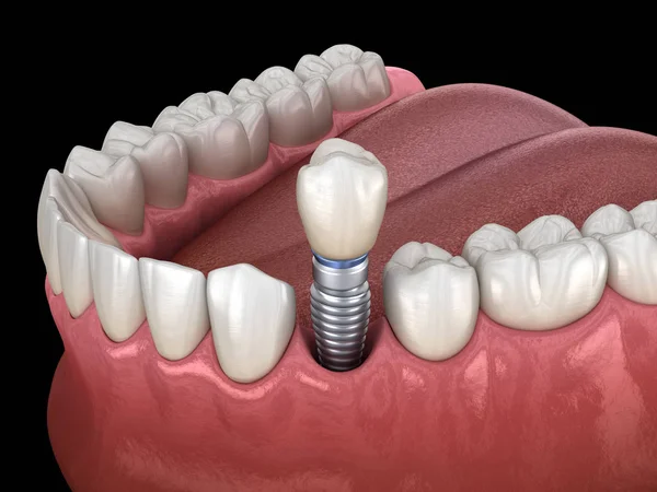 インプラントで前歯の回復 人間の歯と入れ歯の概念の医学的に正確な3Dイラスト — ストック写真