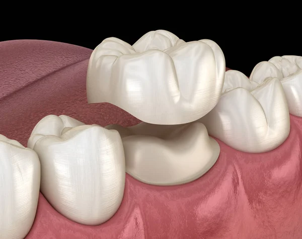 Przygotowany Ząb Trzonowy Umieszczenia Korony Dentystycznej Medycznie Dokładna Ilustracja — Zdjęcie stockowe