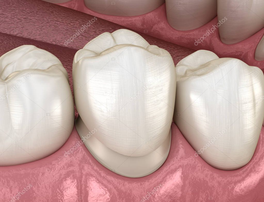 Preparated premolar tooth for dental crown placement. Medically accurate 3D illustration