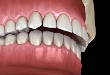 Overbite diş tıkanıklığı ( Diş maloklüzyonu ). Tıbbi olarak doğru diş 3d illüstrasyon