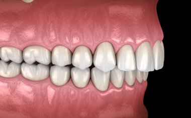 Overbite diş tıkanıklığı ( Diş maloklüzyonu ). Tıbbi olarak doğru diş 3d illüstrasyon