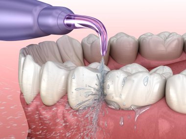 Tahriş edici, su dişleri temizliği. Ağız hijyeni tıbbi olarak doğru 3d illüstrasyon.