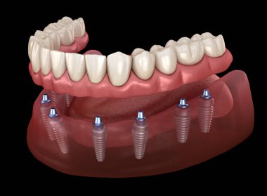 Mandibular protez Tüm 8 sistemi implantlar tarafından desteklenir. İnsan dişleri ve protezkavramının tıbbi olarak doğru 3d illüstrasyon