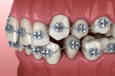 Anormal diş pozisyonu ve metal parantez tretament. Tıbbi olarak doğru diş 3d illüstrasyon